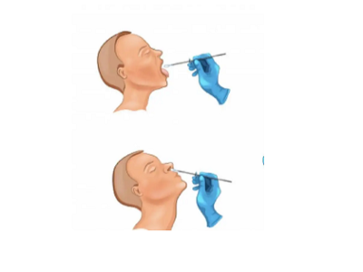 Key points and precautions of nasopharyngeal swab collection